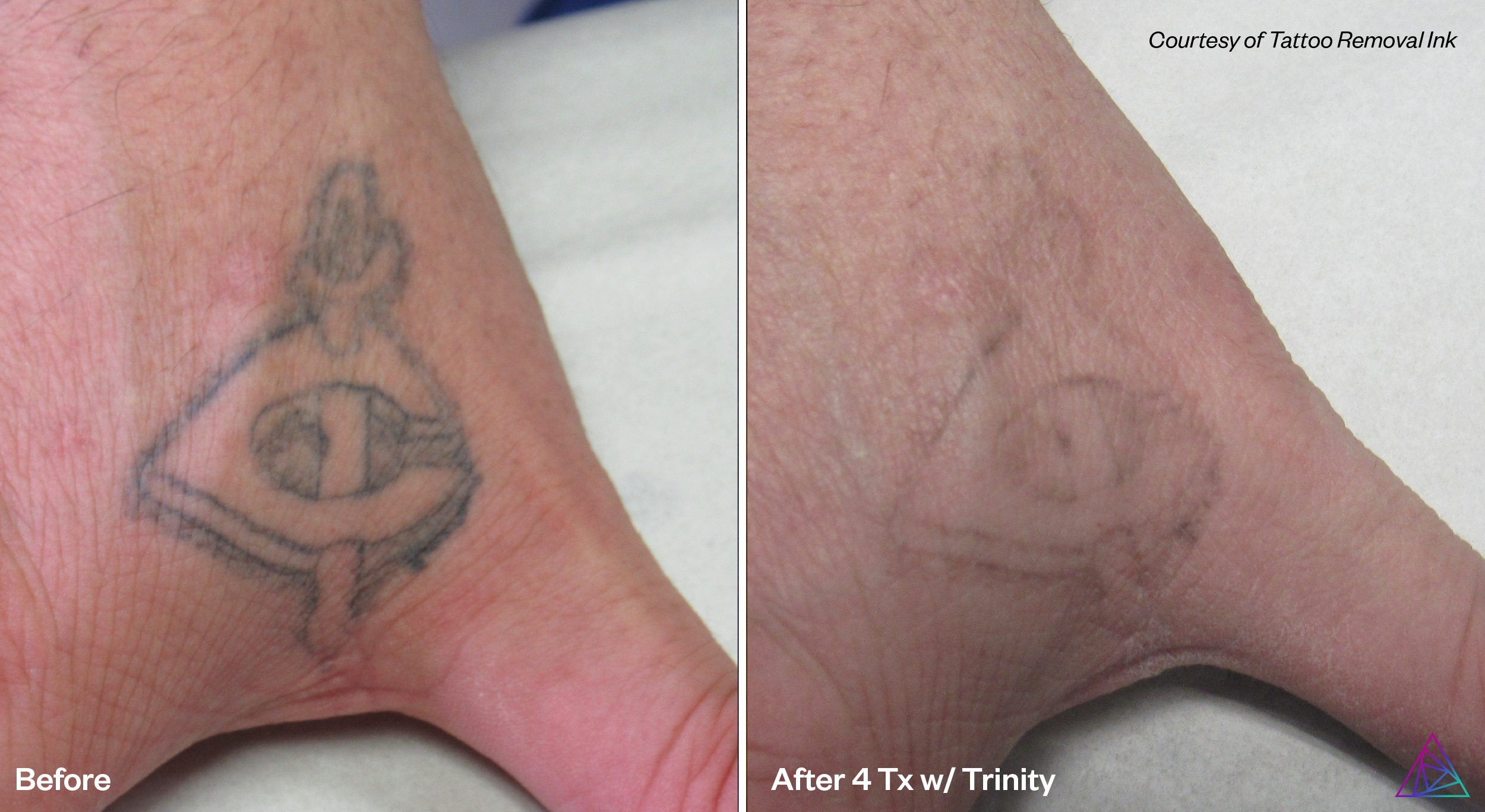 Before and after tattoo removal
